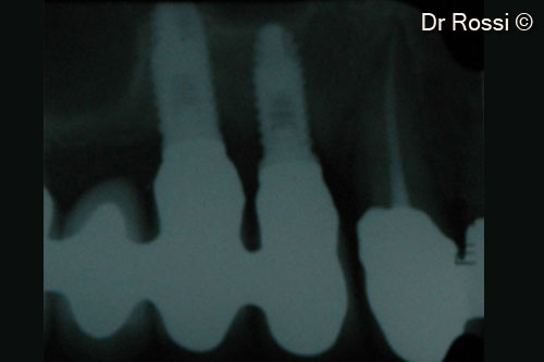 8. Final endoral x-ray (re-entry 1 year after surgery and 8 months after implant loading)