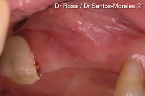 11. Coronal-apical view showing the good rehabilitation of crestal bone defect
