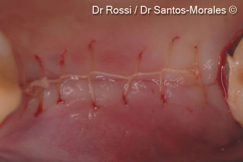 8. Flap suture