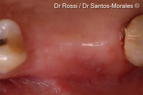 10. Intraoral image after 6 months from grafting