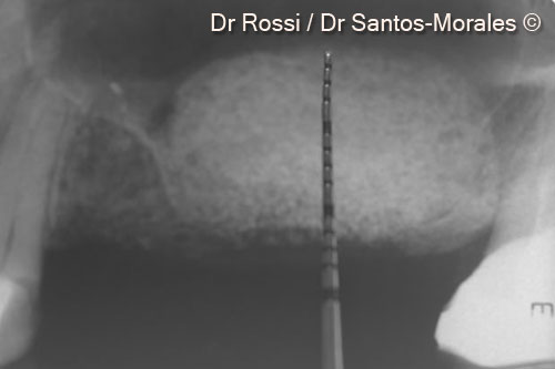 9. Control endoral x-ray immediately after surgery: it is possible to appreciate a bone defect filling of 11 mm