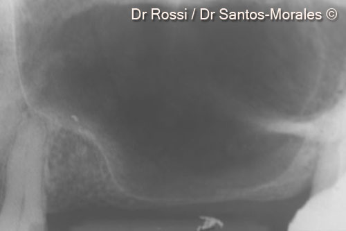 1. Pre-operative endoral x-ray showing a severe crestal atrophy and a wide pneumatization of maxillary sinus