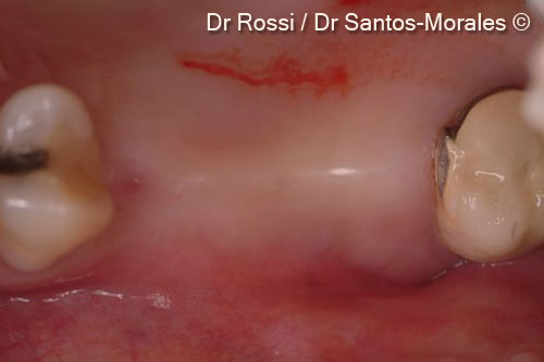 3. View of bone defect in buccal-lingual sense