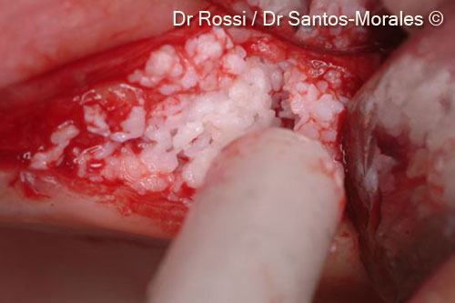 5. Intra-operative image showing the defect filled with OsteoBiol® <i>mp3®</i>