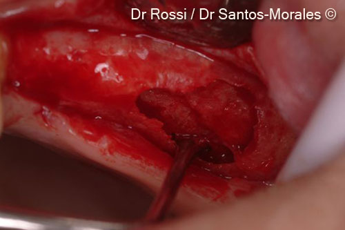 4. The residual crest thickness of 2 mm only prevented lateral access sinus lift procedure. A window crestal approach was chosen. Image showing the sinus membrane dissection