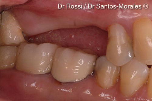 2. Initial intraoral image: view of bone defect in coronal-apical sense