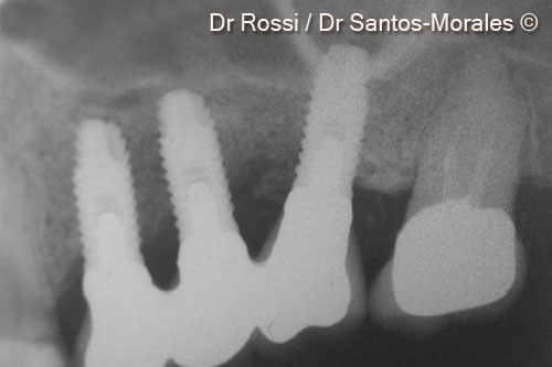 12. Final endoral x-ray