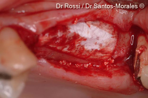 7. The graft was covered and protected with a properly shaped OsteoBiol® <i>Evolution</i> membrane