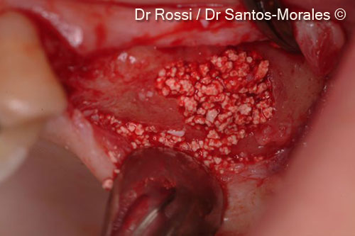 6. The grafted biomaterial was perfectly stabilized with blood clot