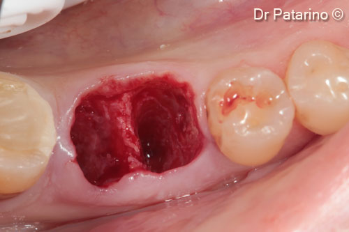 1. Post-extractive alveolus (1st right molar)