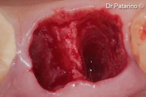 2. Preservation of the bone septum between the roots