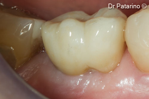 20. Vestibular view of the final cemented crown at 1 month