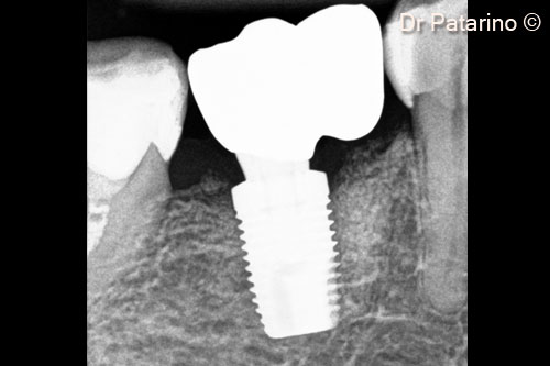 18. Final x-ray