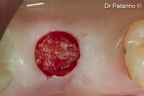 11. Implant positioning with the flapless technique