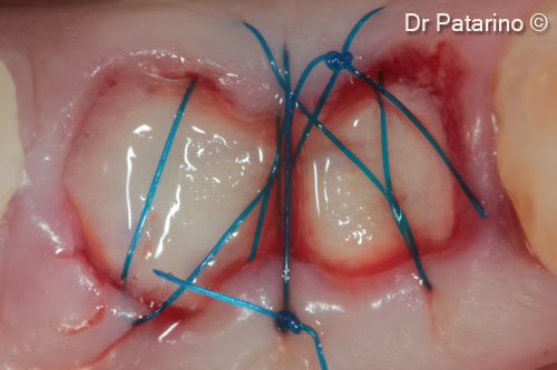 6. OsteoBiol® <i>Derma</i> adjustment to the mucosal walls of the post-extractive socket