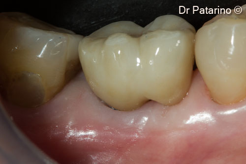 19. Vestibular view of the final cemented crown
