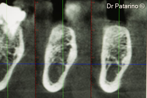 10. CT scan at 3 months