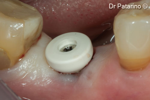 14. Healing abutment