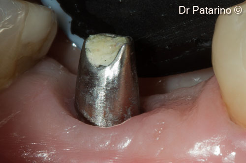 17. Vestibular view of the final abutment before cementation