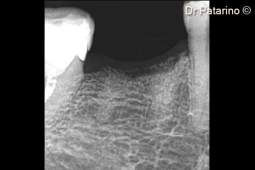 9. X-ray at 3 months