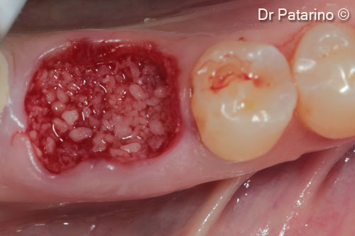 3. <i>Gen-Os®</i> grafting up to the coronal level of the septum