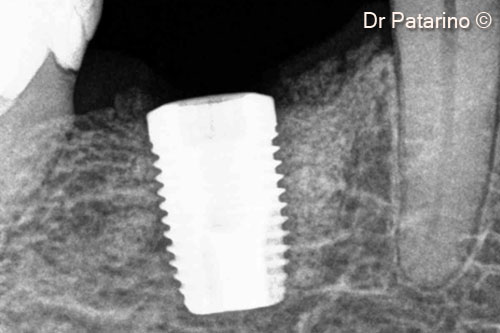 15. X-ray after implant positioning