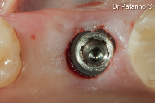 13. Implant positioned