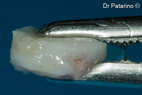 12. Connective tissue harvesting