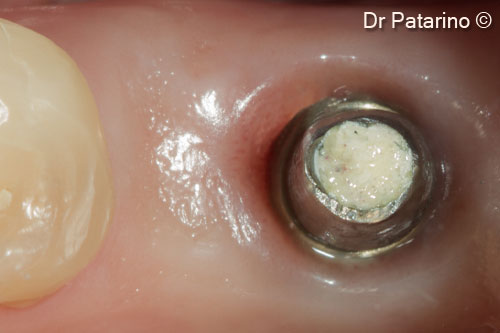 16. Occlusal view of the final abutment before cementation