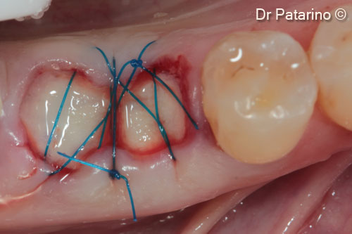5. Sutures after OsteoBiol® <i>Derma</i> positioning