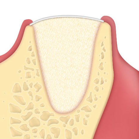 Osteobiol alveolar regeneration