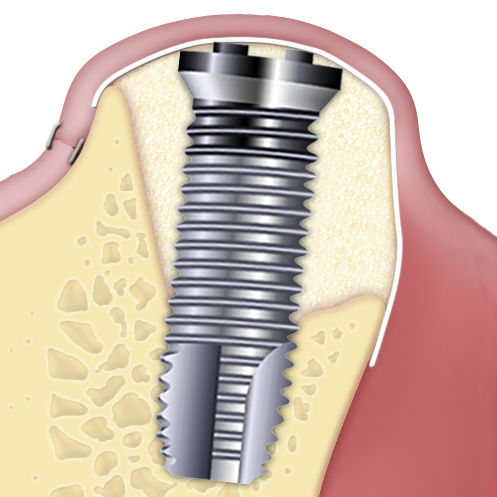 Osteobiol dehiscences and fenestrations