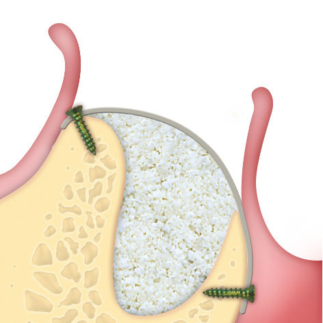 Osteobiol horizontal augmentation