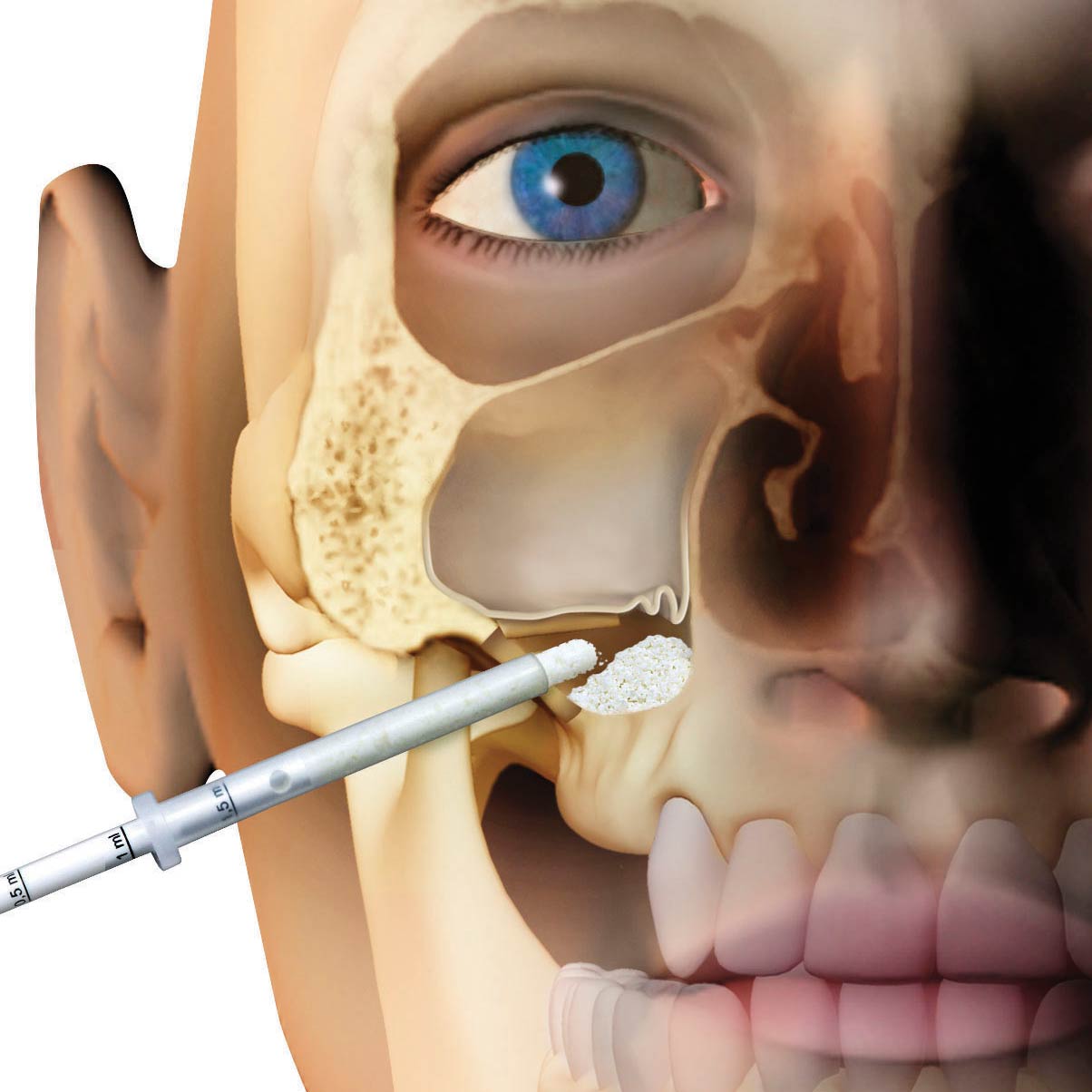 Osteobiol lateral access sinus lift