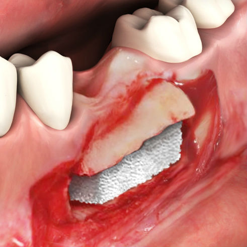 Osteobiol vertical augmentation