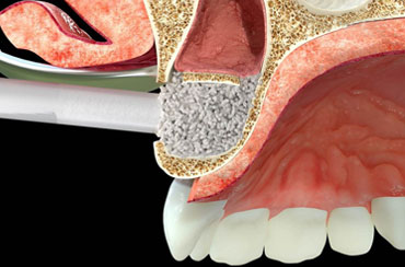 Maxillary sinus lift with mp3®