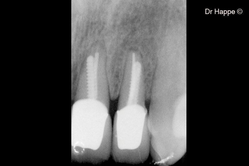 2. Periapical radiograph