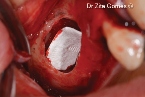 6. OsteoBiol® Evolution membrane protecting the ceiling of the sinus