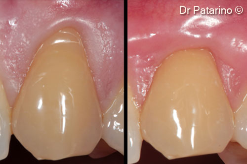 11. Comparison at 2 months