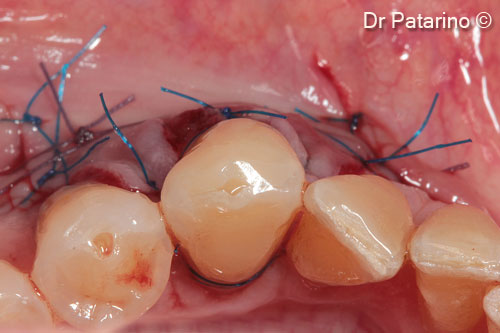 8. Coronally elevated flap to uncover the graft: occlusal view