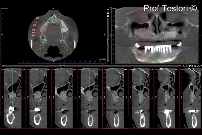11. Immediate post-op panorex after healing and CBCT