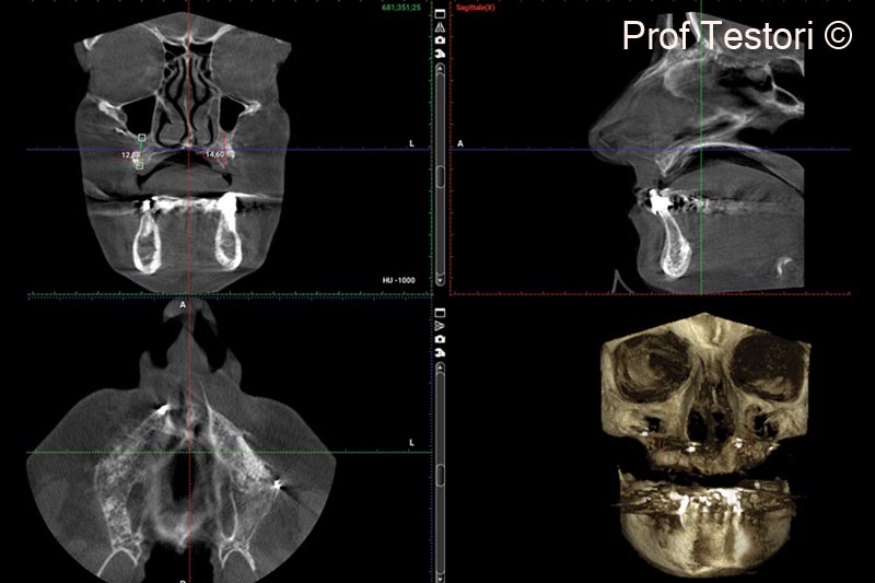12. 6-months follow-up CBCT performed before implant placement