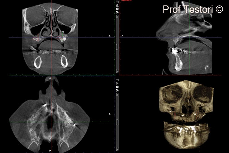 13. 6-months follow-up CBCT performed before implant placement