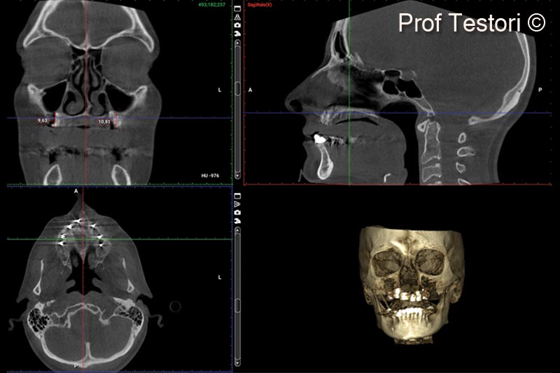 14. 10-months follow-up CBCT before implant uncovering