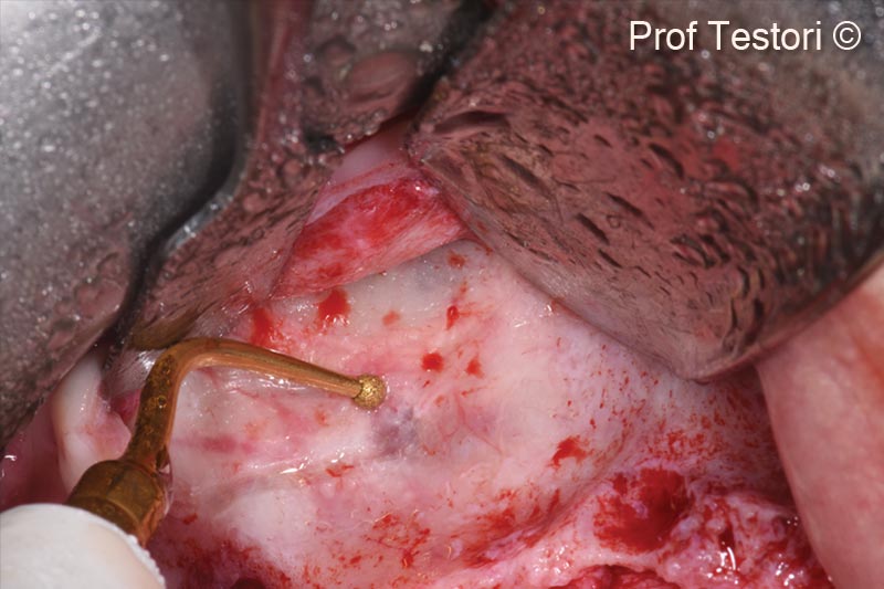 2. Antrostomy Piezosurgery insert
