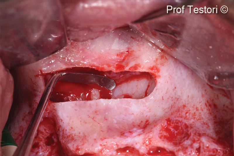 3. Final elevation of the Schneiderian membrane up to the nasal sinus wall