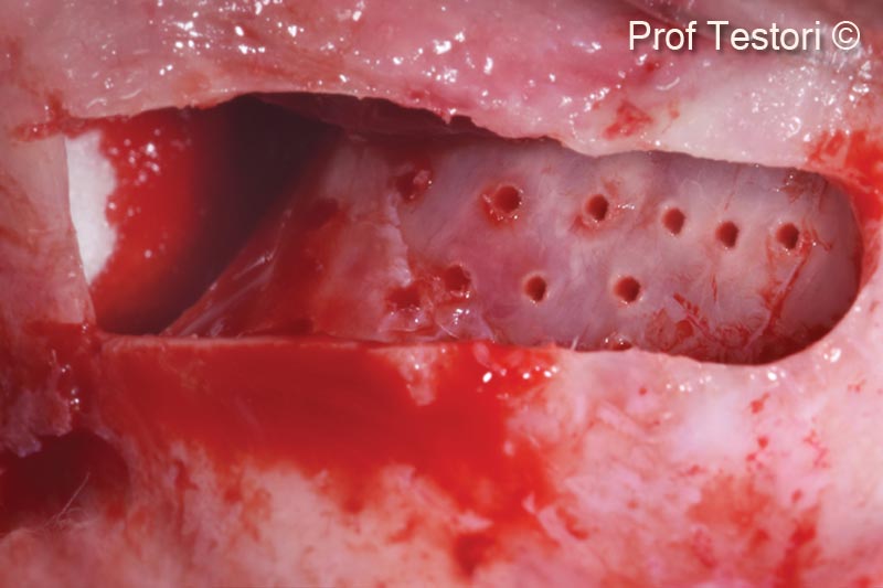 4. Micro perforations of the nasal sinus wall to stimulate bleeding