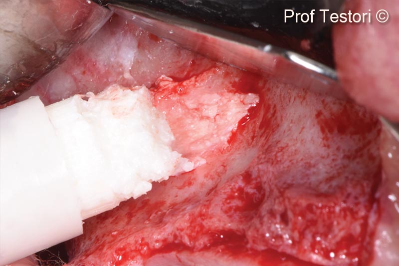 7. Grafting phase with sticky heterologous collagenated bone matrix OsteoBiol® GTO®