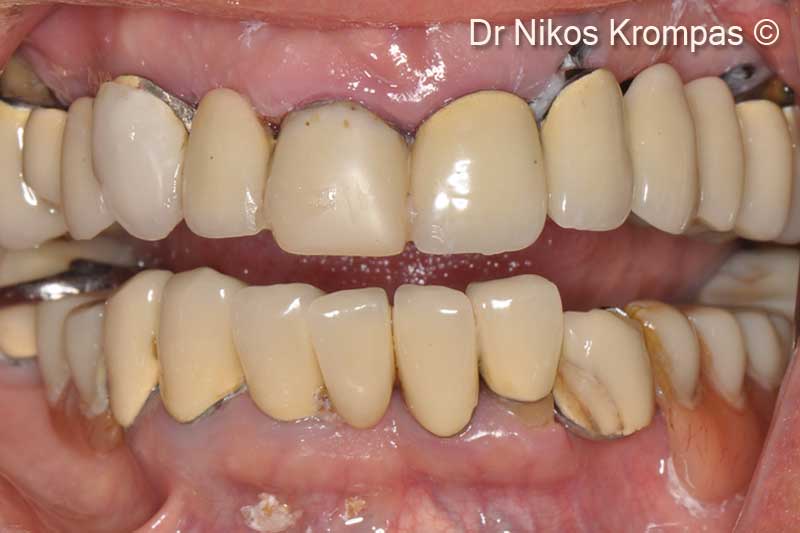 1. Failing maxillary dentition