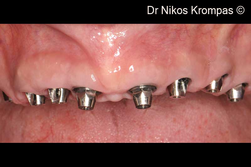 10. Buccal view of the healed ridge after 8 months